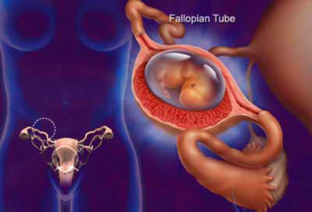 Có thai ngoài tử cung là như thế nào?